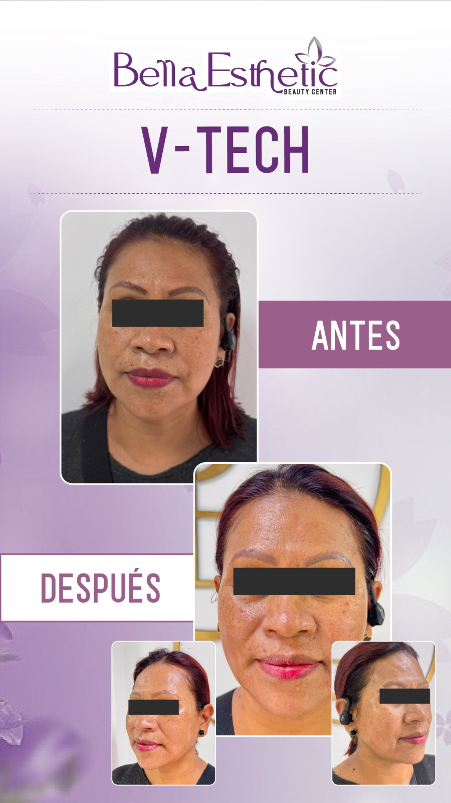 Resultado de Tratamiento 1