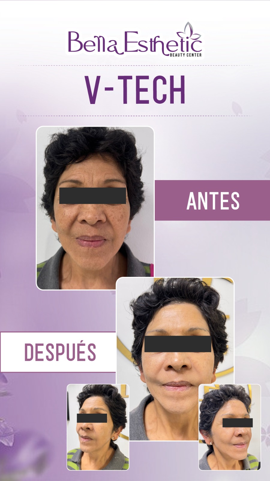 Resultado de Tratamiento 2