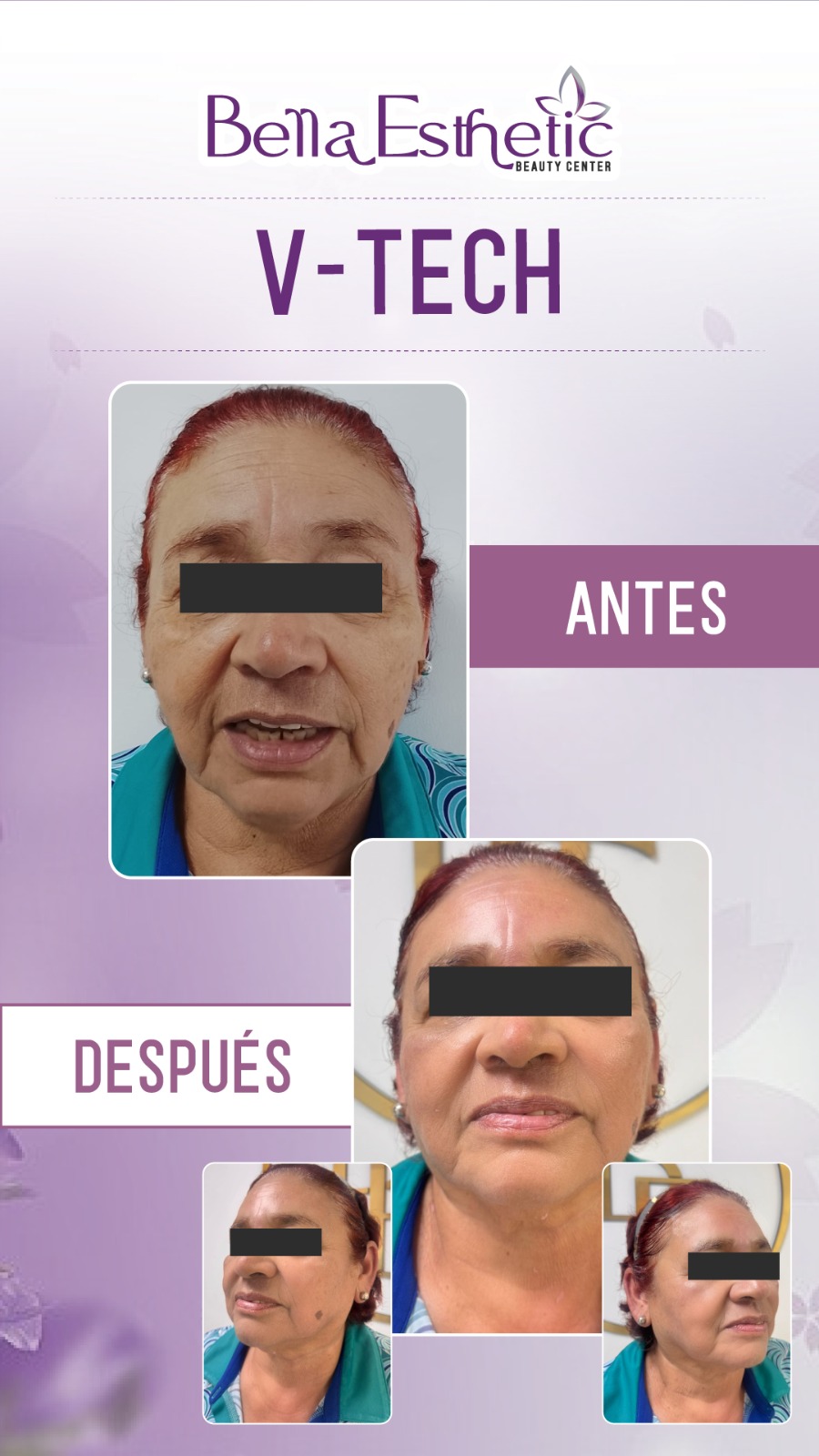 Resultado de Tratamiento 3