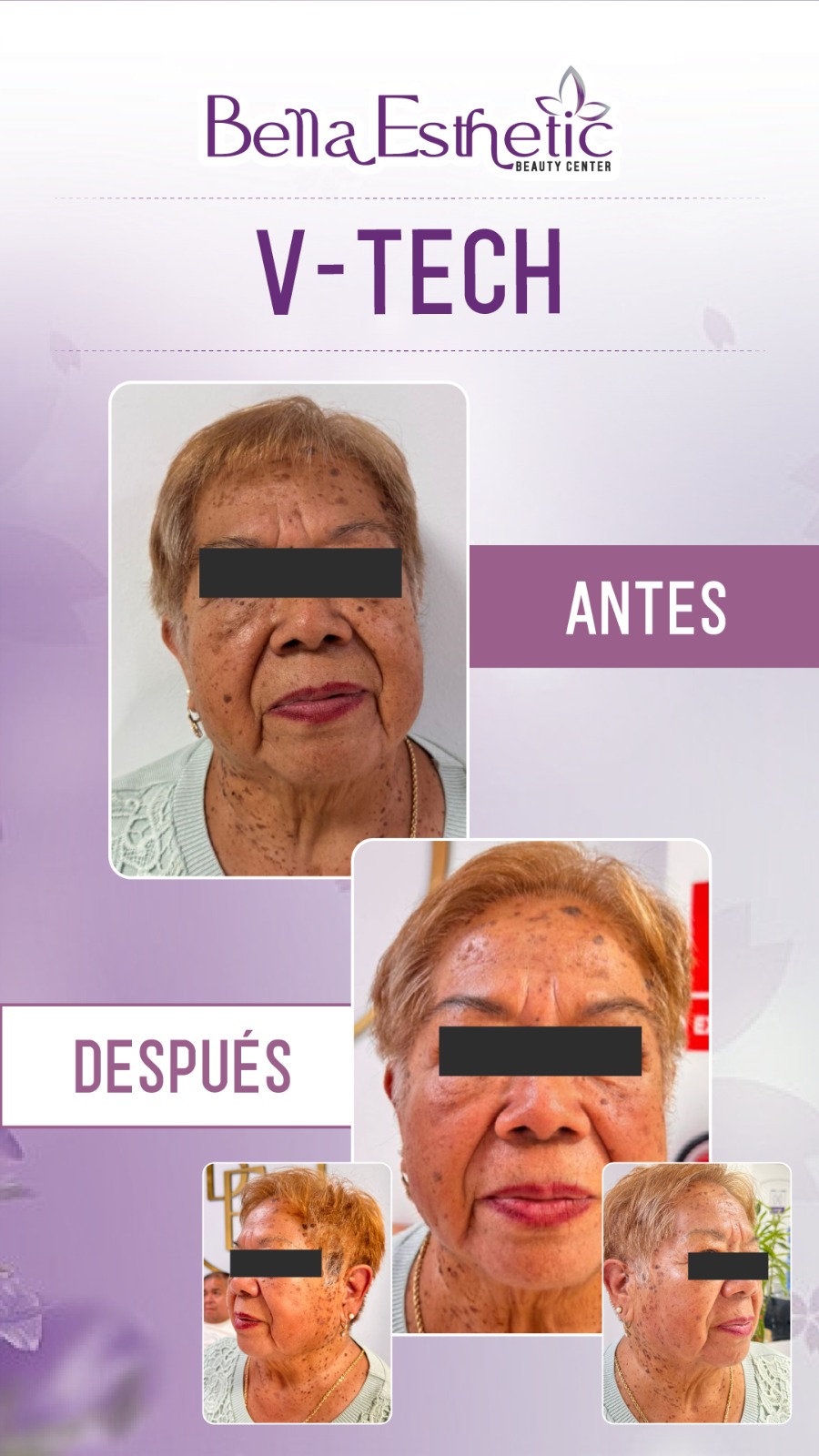 Resultado de Tratamiento 4